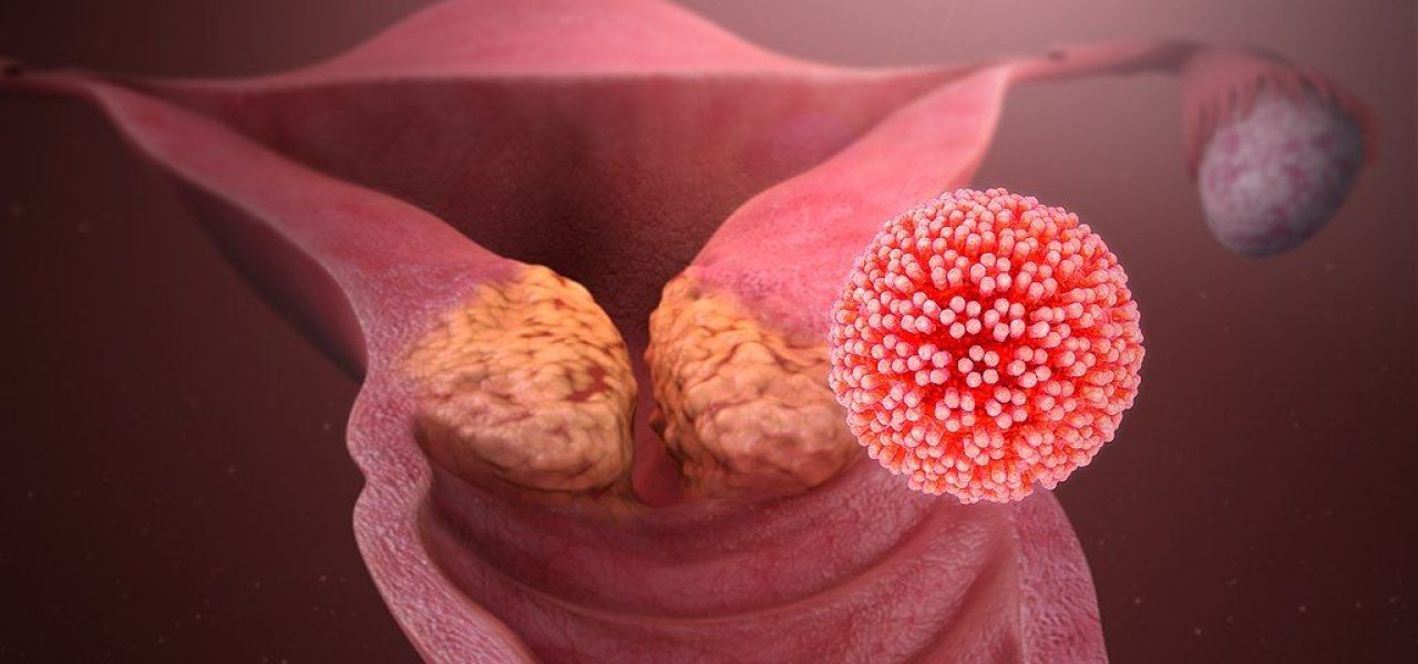 Virus de papiloma y cáncer de cérvix